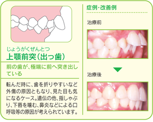 出っ歯