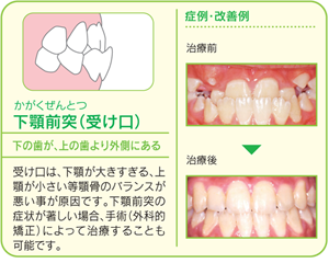 受け口