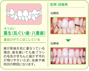 乱ぐい歯・八重歯